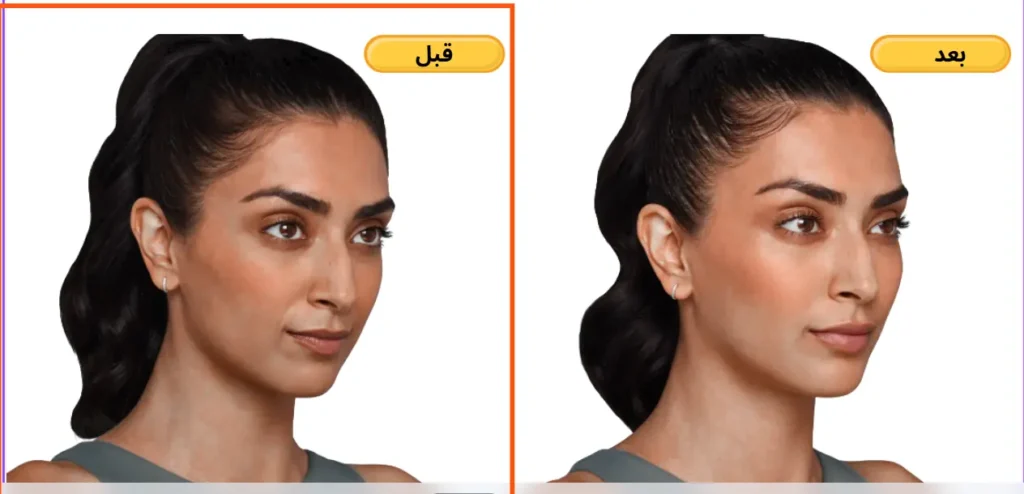 النتائج قبل وبعد الفيلر 